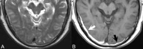 硬膜外、硬膜下出血与蛛网膜下腔出血磁共振影像学表现